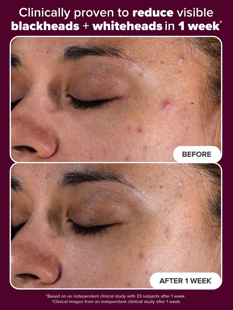 holiday edition 2 bha eksfolierende toner